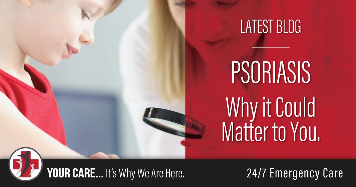 Psoriasis – Why it Could Matter to You